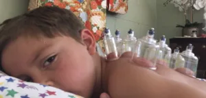 Child receiving cupping treatment